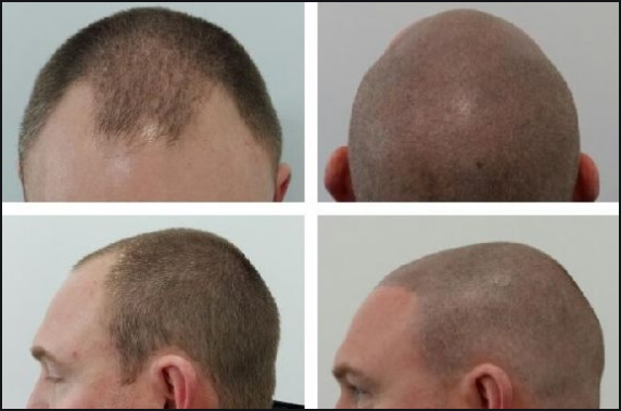 No More Hair Loss with SMP